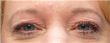 Eyelid Surgery Before Photo by Ellen Mahony, MD; Westport, CT - Case 42975