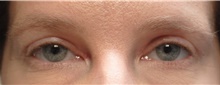 Eyelid Surgery After Photo by Ellen Mahony, MD; Westport, CT - Case 42976