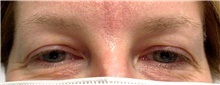 Eyelid Surgery Before Photo by Ellen Mahony, MD; Westport, CT - Case 42976