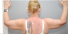 Arm Lift After Photo by Ellen Mahony, MD; Westport, CT - Case 42978