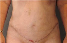 Tummy Tuck After Photo by Ellen Mahony, MD; Westport, CT - Case 43087