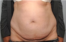 Tummy Tuck Before Photo by Ellen Mahony, MD; Westport, CT - Case 43087