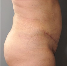 Tummy Tuck After Photo by Ellen Mahony, MD; Westport, CT - Case 43087