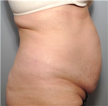 Tummy Tuck Before Photo by Ellen Mahony, MD; Westport, CT - Case 43087