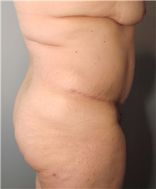 Tummy Tuck Before Photo by Ellen Mahony, MD; Westport, CT - Case 43090