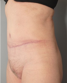 Tummy Tuck After Photo by Ellen Mahony, MD; Westport, CT - Case 43212