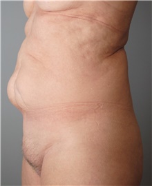 Tummy Tuck Before Photo by Ellen Mahony, MD; Westport, CT - Case 43212