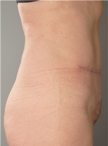 Tummy Tuck After Photo by Ellen Mahony, MD; Westport, CT - Case 43212