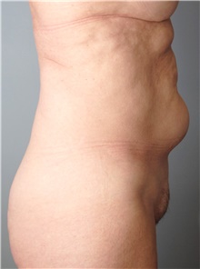 Tummy Tuck Before Photo by Ellen Mahony, MD; Westport, CT - Case 43212