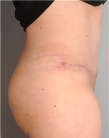 Tummy Tuck After Photo by Ellen Mahony, MD; Westport, CT - Case 44560