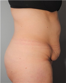 Tummy Tuck Before Photo by Ellen Mahony, MD; Westport, CT - Case 44560