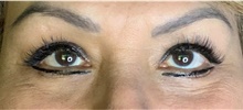 Eyelid Surgery After Photo by Ellen Mahony, MD; Westport, CT - Case 44565