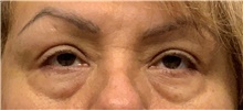 Eyelid Surgery Before Photo by Ellen Mahony, MD; Westport, CT - Case 44565