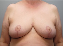 Breast Reduction After Photo by Ellen Mahony, MD; Westport, CT - Case 44682