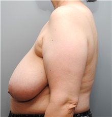 Breast Reduction Before Photo by Ellen Mahony, MD; Westport, CT - Case 44682