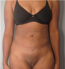 Tummy Tuck After Photo by Ellen Mahony, MD; Westport, CT - Case 44903