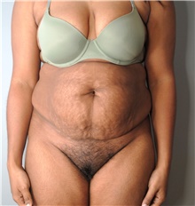 Tummy Tuck Before Photo by Ellen Mahony, MD; Westport, CT - Case 44903