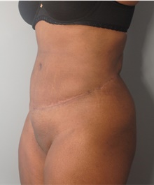 Tummy Tuck After Photo by Ellen Mahony, MD; Westport, CT - Case 44903