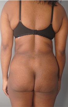 Tummy Tuck After Photo by Ellen Mahony, MD; Westport, CT - Case 44903