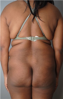 Tummy Tuck Before Photo by Ellen Mahony, MD; Westport, CT - Case 44903