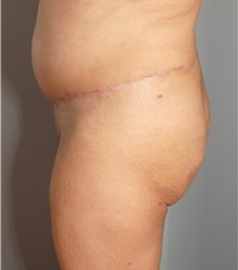 Tummy Tuck After Photo by Ellen Mahony, MD; Westport, CT - Case 44907