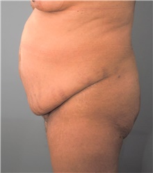 Tummy Tuck Before Photo by Ellen Mahony, MD; Westport, CT - Case 44907