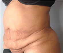 Tummy Tuck Before Photo by Ellen Mahony, MD; Westport, CT - Case 44917