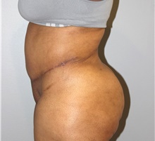 Tummy Tuck After Photo by Ellen Mahony, MD; Westport, CT - Case 44917