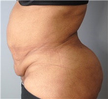 Tummy Tuck Before Photo by Ellen Mahony, MD; Westport, CT - Case 44917