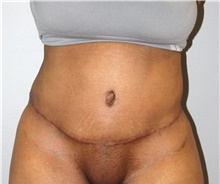 Tummy Tuck After Photo by Ellen Mahony, MD; Westport, CT - Case 44917