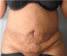 Tummy Tuck Before Photo by Ellen Mahony, MD; Westport, CT - Case 44917