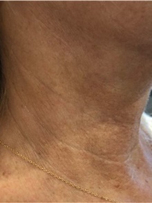 Dermal Fillers After Photo by Ellen Mahony, MD; Westport, CT - Case 44919