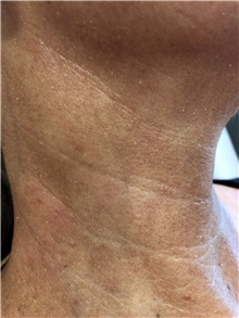 Dermal Fillers Before Photo by Ellen Mahony, MD; Westport, CT - Case 44919