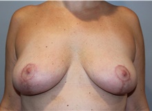 Breast Lift After Photo by Ellen Mahony, MD; Westport, CT - Case 44991