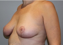 Breast Lift After Photo by Ellen Mahony, MD; Westport, CT - Case 44991