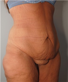Tummy Tuck Before Photo by Ellen Mahony, MD; Westport, CT - Case 44992