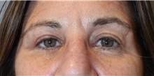 Eyelid Surgery After Photo by Ellen Mahony, MD; Westport, CT - Case 45416