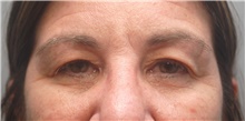 Eyelid Surgery Before Photo by Ellen Mahony, MD; Westport, CT - Case 45416