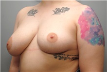 Breast Reduction Before Photo by Ellen Mahony, MD; Westport, CT - Case 45419