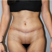 Tummy Tuck After Photo by Ellen Mahony, MD; Westport, CT - Case 45421