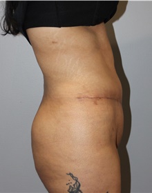 Tummy Tuck After Photo by Ellen Mahony, MD; Westport, CT - Case 45421