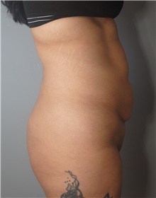 Tummy Tuck Before Photo by Ellen Mahony, MD; Westport, CT - Case 45421