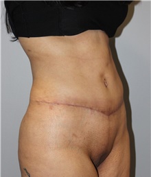 Tummy Tuck After Photo by Ellen Mahony, MD; Westport, CT - Case 45421