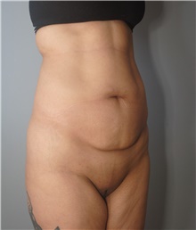 Tummy Tuck Before Photo by Ellen Mahony, MD; Westport, CT - Case 45421