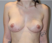 Breast Reduction After Photo by Ellen Mahony, MD; Westport, CT - Case 45549