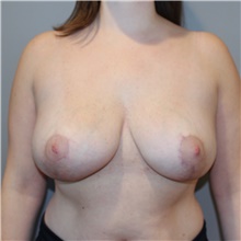 Breast Reduction After Photo by Ellen Mahony, MD; Westport, CT - Case 46035