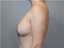 Breast Reduction After Photo by Ellen Mahony, MD; Westport, CT - Case 46039