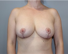 Breast Reduction After Photo by Ellen Mahony, MD; Westport, CT - Case 46039