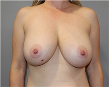 Breast Reduction Before Photo by Ellen Mahony, MD; Westport, CT - Case 46039