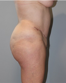 Tummy Tuck After Photo by Ellen Mahony, MD; Westport, CT - Case 46179